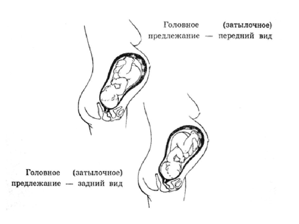 Предлежание головка это как