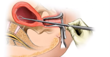 Возможно ли забеременеть после выскабливания