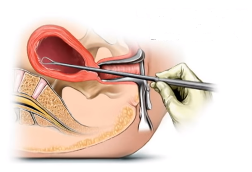 Возможно ли забеременеть после выскабливания
