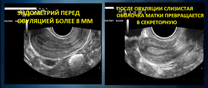 Эндометрий толщина для зачатия. Матка после овуляции УЗИ. Трехслойный эндометрий.