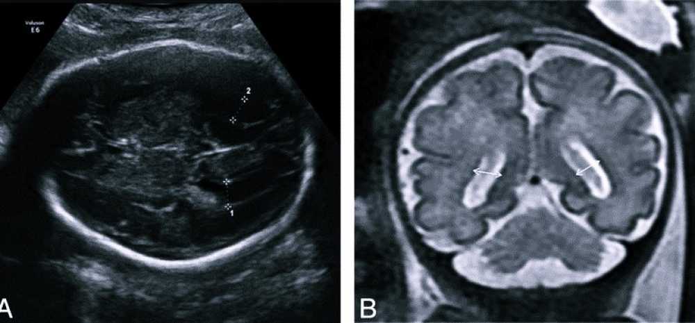 Вентрикуломегалия у плода односторонняя