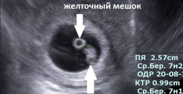 На каком сроке визуализируется эмбрион в плодном яйце