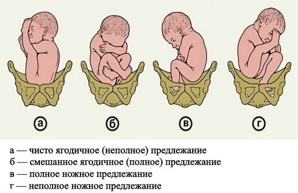 Если ребенок лежит в тазовом предлежании что делать