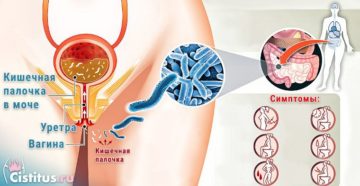 Чем опасна кишечная палочка при беременности в моче