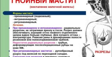 Гнойный мастит при грудном вскармливании