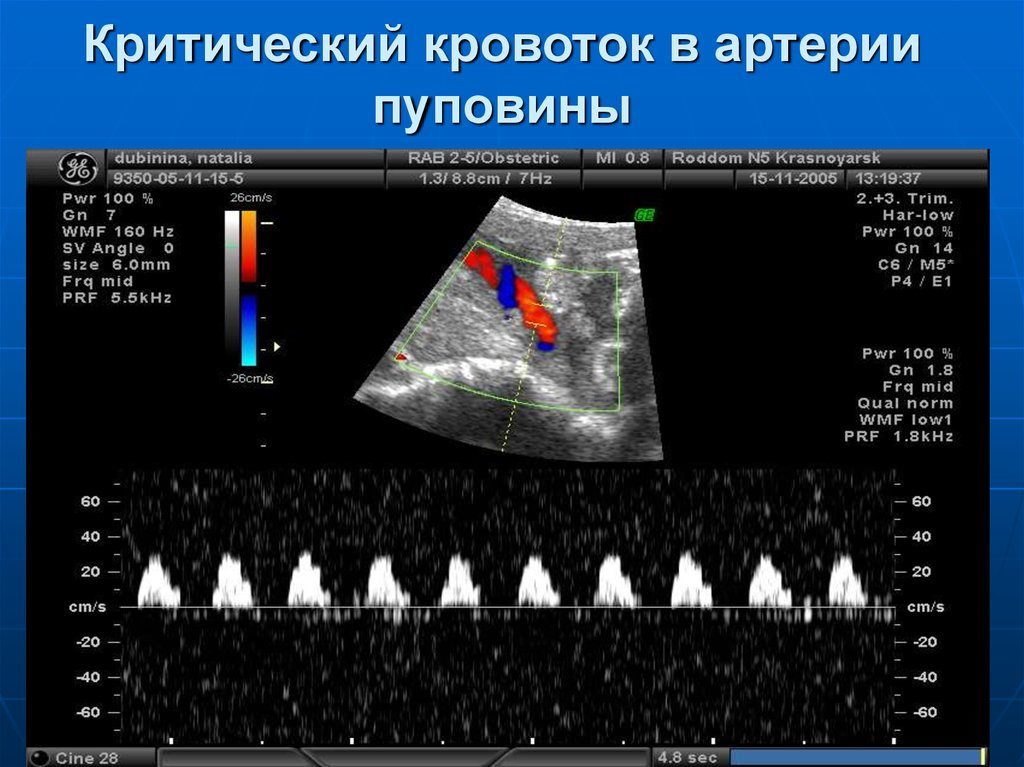 Кровоток нулевой в пуповине