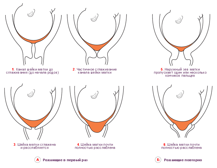 Открытие шейки матки на 4 см когда рожать