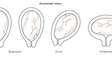 Головное предлежание плода поперечное