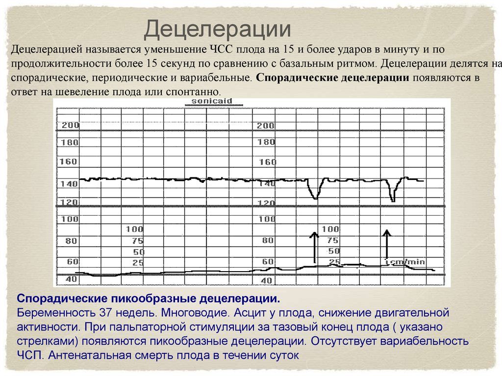 При ктг 1 децелерация