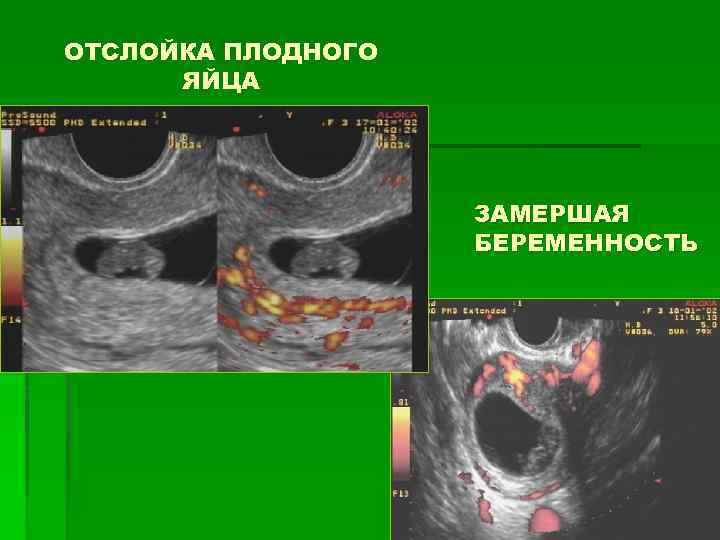 Частичная отслойка плодного яйца на ранних сроках беременности