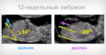 Можно узнать пол ребенка на 12 недели беременности