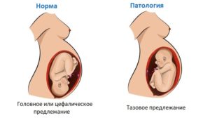 Как перевернуть малыша из тазового в головное