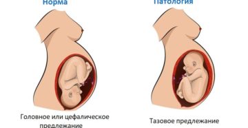 Как перевернуть малыша из тазового в головное