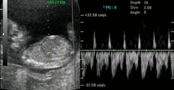 Реверсный кровоток у плода