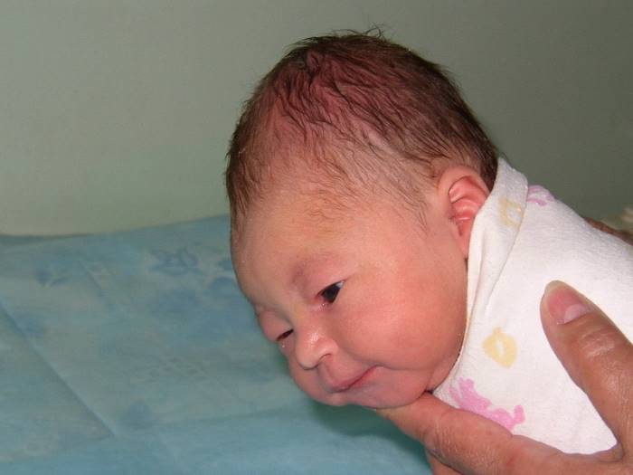 Гемангиома на затылке у новорожденного фото