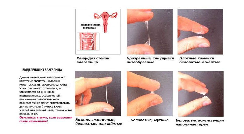 От чего берется молочница