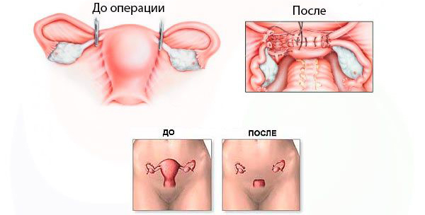 После удаления матки приливы