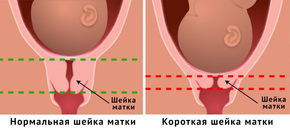 Короткая но закрытая шейка матки