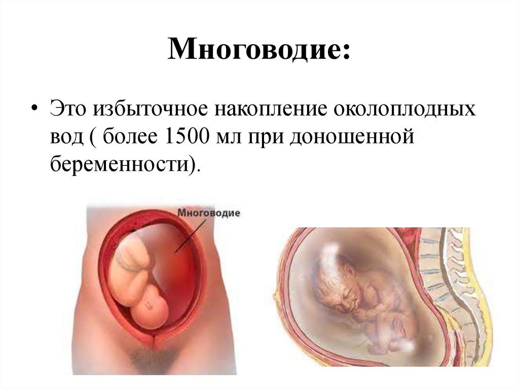 Многоводие 34 неделя беременности