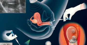 Сердцебиение после переноса эмбрионов