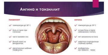 При беременности насморк и болит горло чем лечить