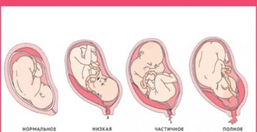 Плацента по задней стенке низко что это значит