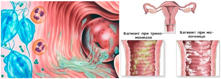 Непроходящая молочница при беременности