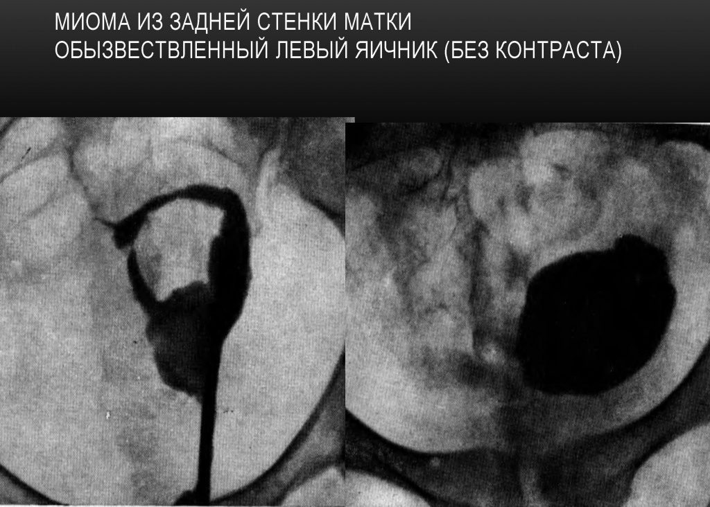 Миома матки задней стенки