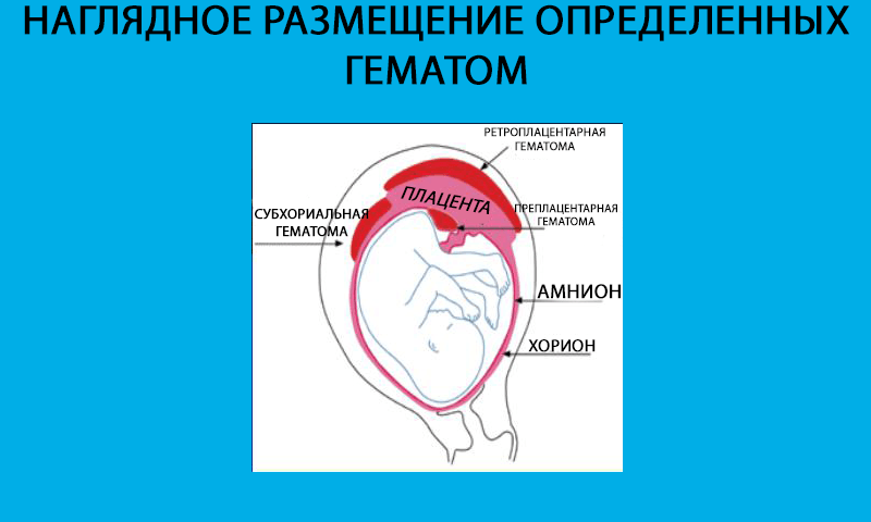 Ретрооболочечная гематома при беременности