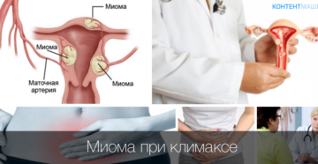 Миома при климаксе исчезает