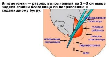 После эпизиотомии когда можно сидеть