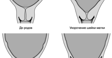 Роды раскрытие шейки матки