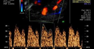 Кровоток в венозном протоке у плода норма