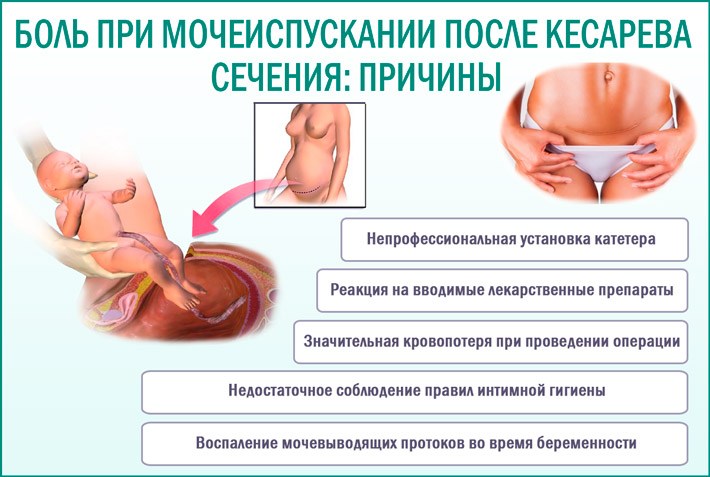 Дискомфорт после родов при мочеиспускании