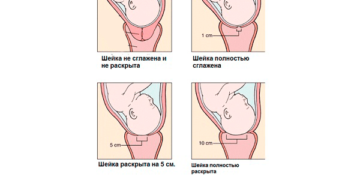 Сглажена шейка что значит