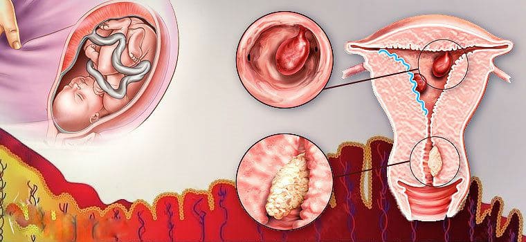 Полип в матке при беременности на ранних сроках