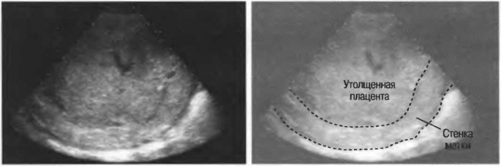 Плацента увеличена при беременности