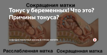 Причины тонуса матки без беременности причины