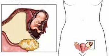 Яичники увеличиваются при беременности