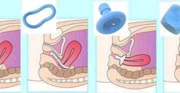 Когда ставят кольцо на шейку матки при беременности