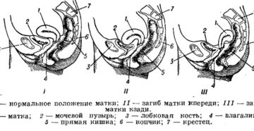 Матка отклонена кзади что это значит при беременности