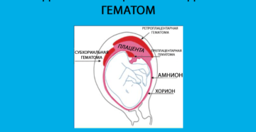 Субамниотическая гематома при беременности что это такое