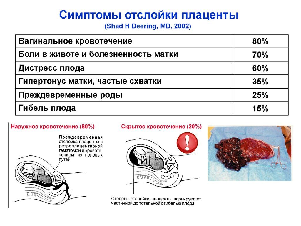 Отслойка плаценты симптомы форум