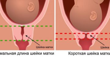 Шейка мягкая при беременности