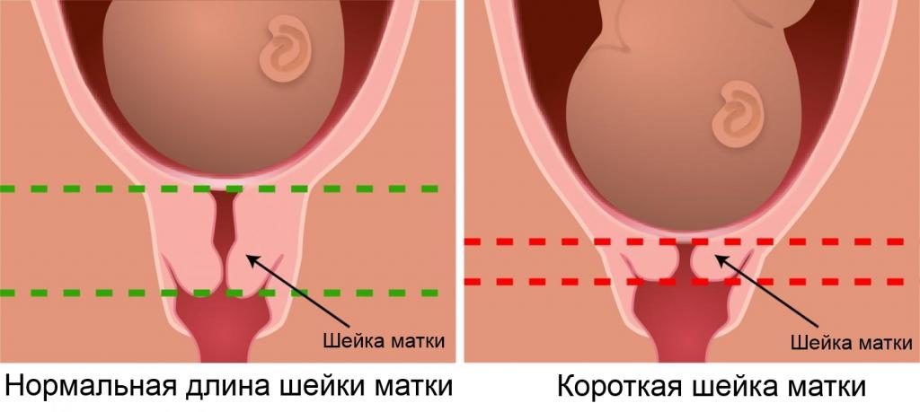 При беременности матка укороченная