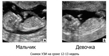 Определение пола ребенка по узи в 13 недель