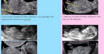 На какой неделе точно можно определить пол ребенка