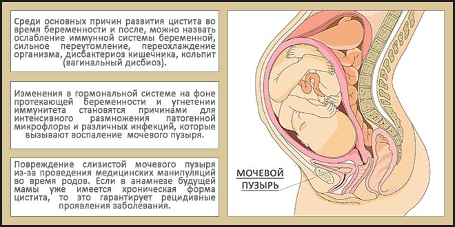 Болит мочевой пузырь после родов