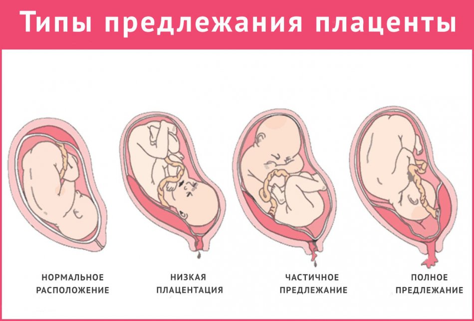 Что значит плацента низкая