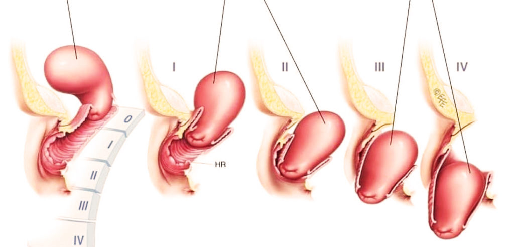 Опущение матки при беременности